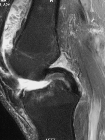 Synovial Chondromatosis MRI Knee